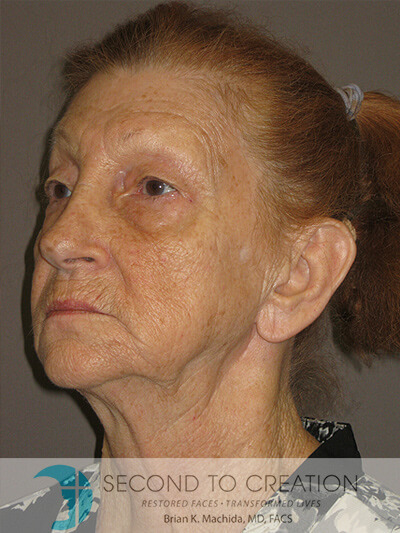 before blepharoplasty left angle view of female patient 4