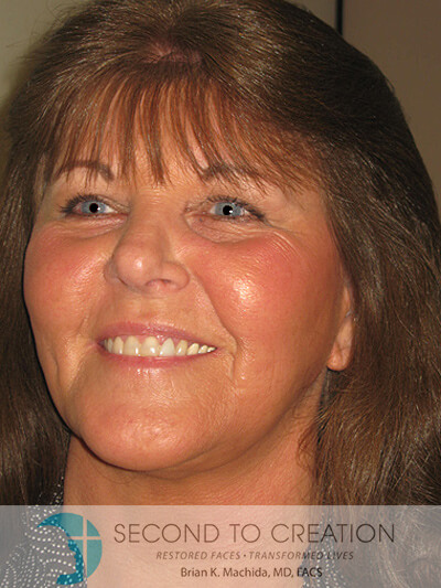 after blepharoplasty left angle view of female patient 6