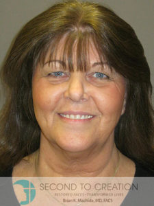 before blepharoplasty front view of female patient 6