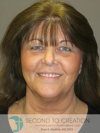 before blepharoplasty front view of female patient 6