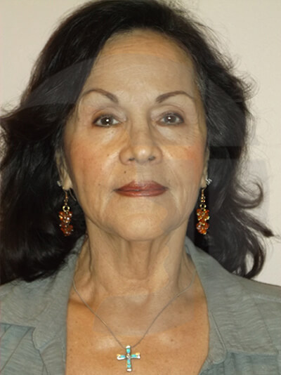 before facelift front view of female patient 1