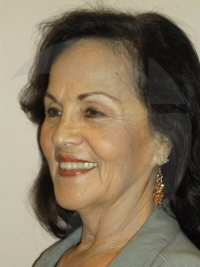 before facelift left angle view of female patient 1