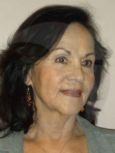 before facelift right angle view of female patient 1