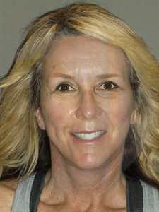 after facelift front view of female patient 3