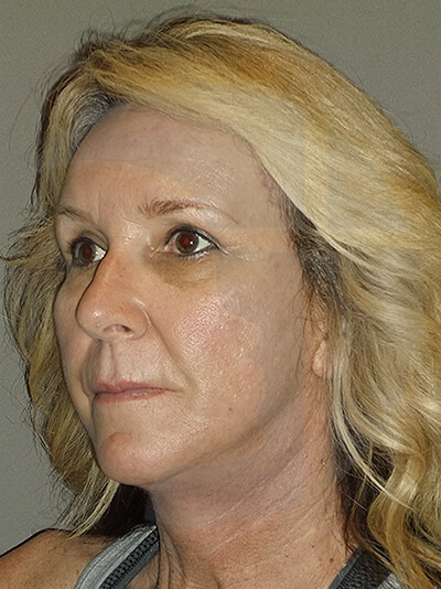 after facelift left angle view of female patient 3