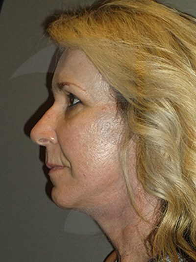 after facelift left side view of female patient 3