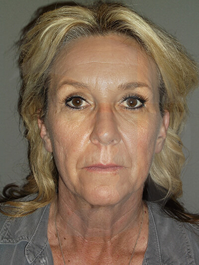 before facelift front view of female patient 3