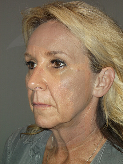 before facelift left angle view of female patient 3