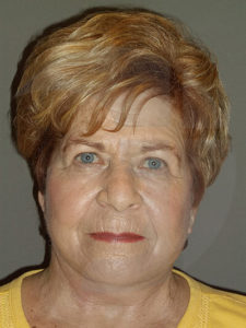 after facelift front view of female patient 4