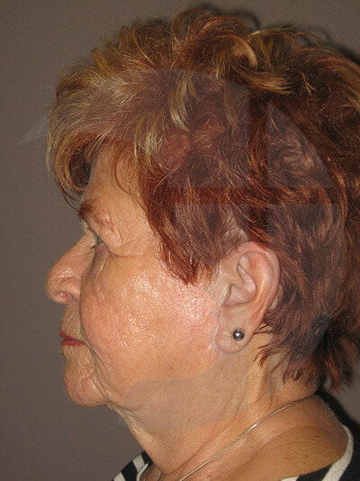 before facelift left side view of female patient 4