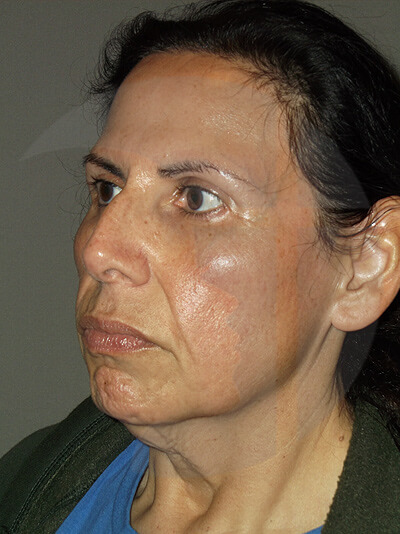 before facelift left angle view of female patient 5