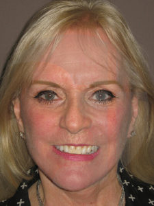 after facelift front view of female patient 7