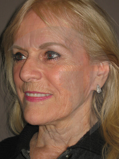 before facelift left angle view of female patient 7