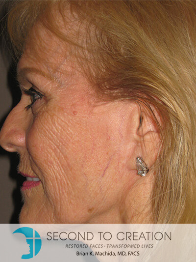 before facelift left side closeup view of female patient 7
