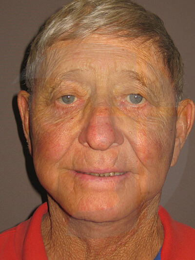 front facelift front view of male patient 8