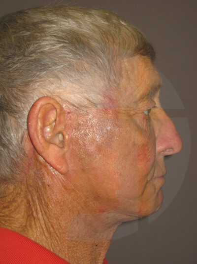 after facelift left side view of male patient 8