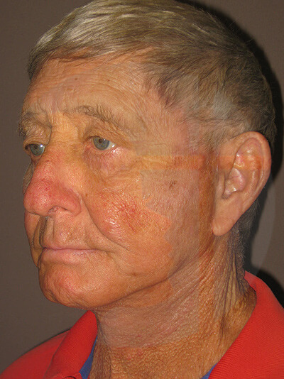 after facelift left angle view of male patient 8