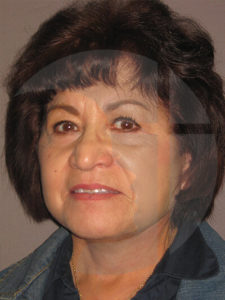 after facelift left angle view of female patient 9