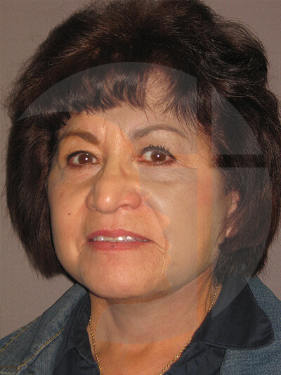 after facelift left angle view of female patient 9