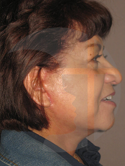 after facelift right side view of female patient 9