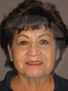 before facelift front view of female patient 9