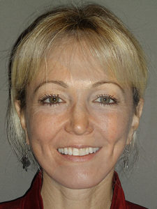 after facelift front view of female patient 11