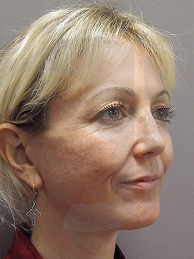 after facelift right angle view of female patient 11