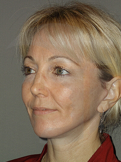 after facelift left angle view of female patient 11