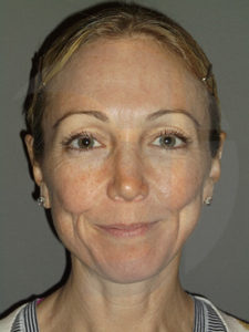 before facelift front view of female patient 11