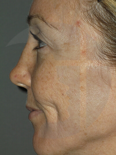 before facelift left side closeup view of female patient 11
