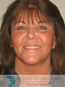 after facelift left angle view of female patient 983