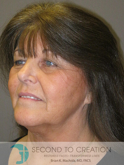 before facelift left angle view of female patient 983