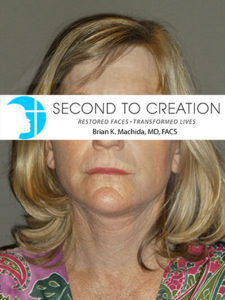 after facelift front view of female patient 2