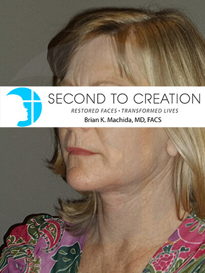 after facelift left angle view of female patient 2