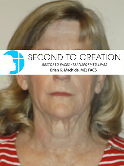 before facelift front view of female patient 2