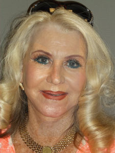 after facelift front view of female patient 6