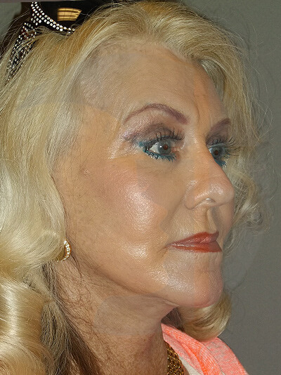 after facelift right angle view of female patient 6
