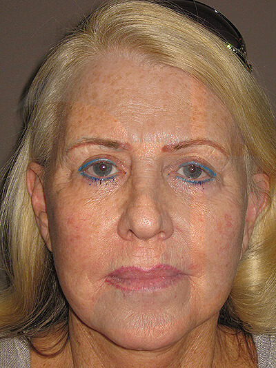 before facelift front view of female patient 6