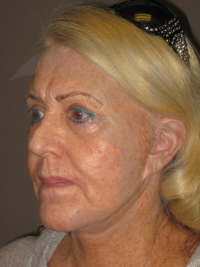before facelift left angle view of female patient 6
