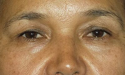 before blepharoplasty front view of patient 1