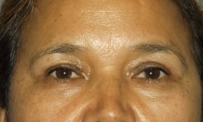 after blepharoplasty front view of patient 1