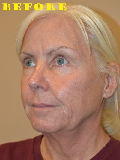 before facelift left angle view of female patient case 68