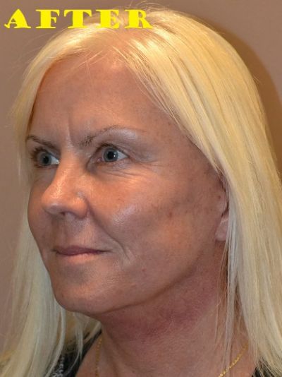 after facelift left angle view of female patient case 68