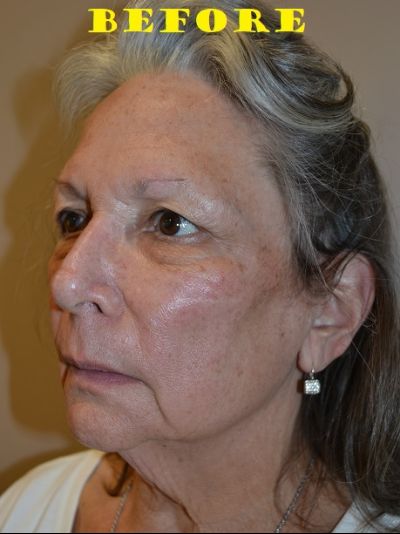 before facelift angle left view of female patient case 69