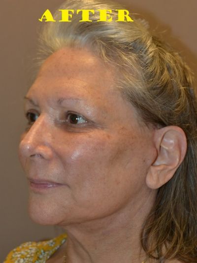 after facelift angle left view of female patient case 69