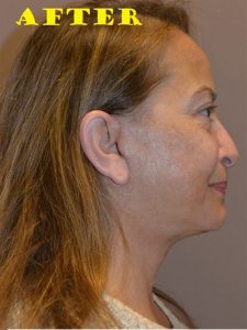 after facelift right view of female patient case 70