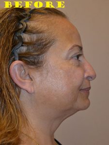before facelift right view of female patient case 70