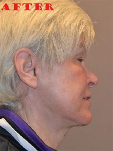 after facelift right view of female patient case 71