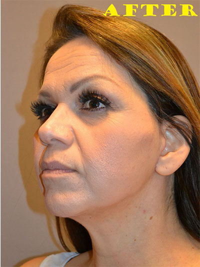 after facelift left angle view of female patient case 72