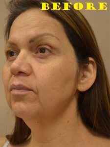 before facelift left angle view of female patient case 72